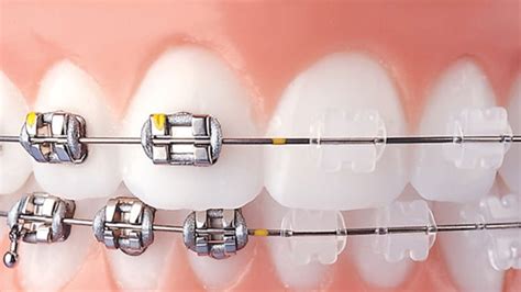 que es mejor brackets metalicos o de ceramica|Brackets Cerámicos Y Metálicos: 7 Puntos De .